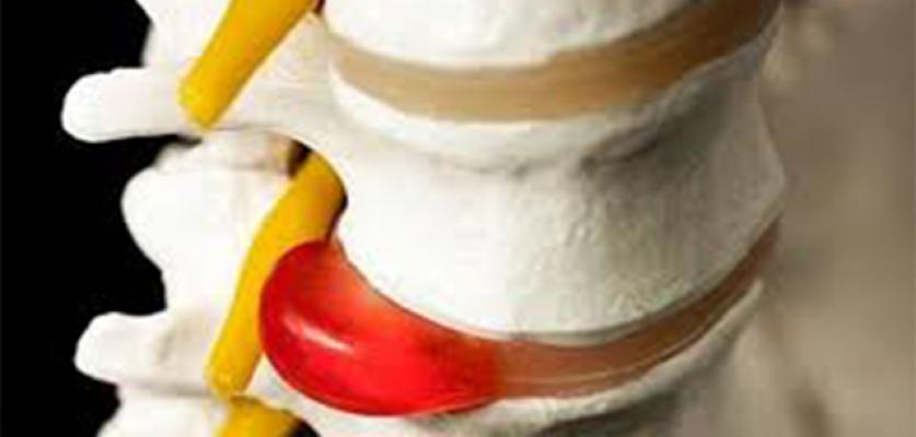 Bel Fıtığına Kalıcı Çözüm