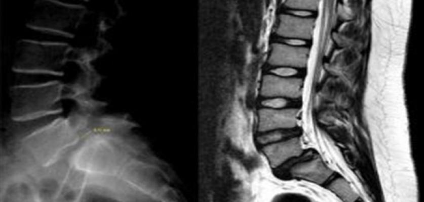 Bel Kaymasında Ameliyatsız Tedavi Mümkün mü?