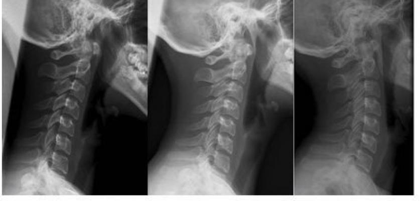 Boyun Düzleşmesinde Yalancı Fıtığa Dikkat!