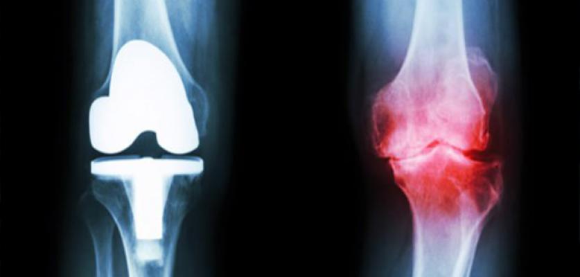 Eklem Kireçlenmeleri