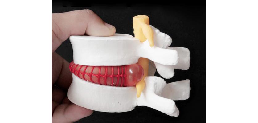 Fıtığın Patlaması Felce Sebep Olur mu?