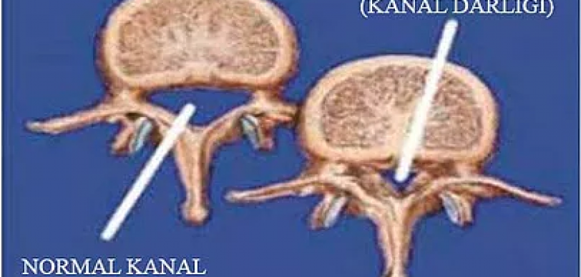 Kanal Darlığı Tedavi Edilebilir mi?