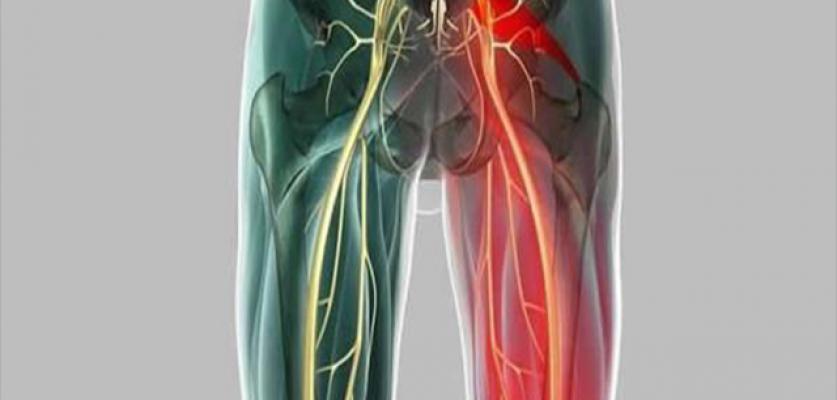 Siyatik Sıkışması