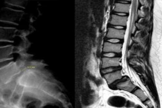 Bel Kaymasında Ameliyatsız Tedavi Mümkün mü?