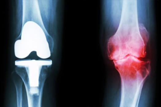 Eklem Kireçlenmeleri