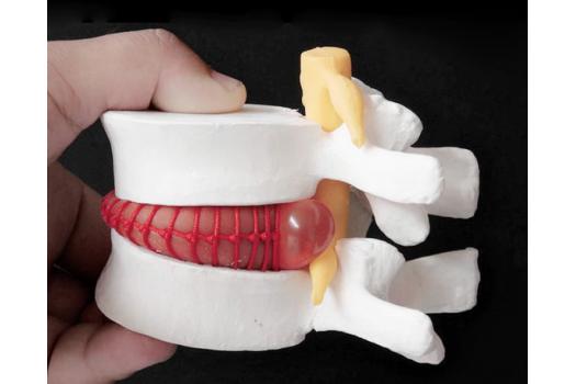 Fıtığın Patlaması Felçe Sebep Olur mu?