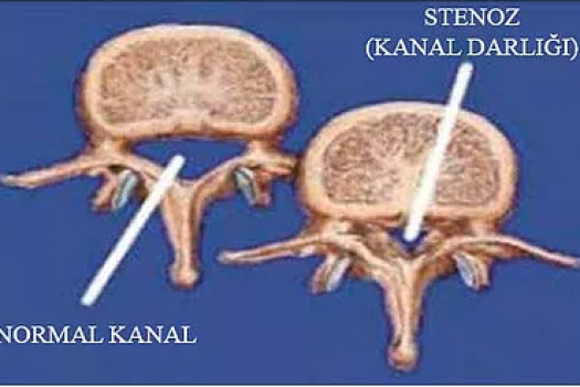 Kanal Darlığı Tedavi Edilebilir mi?